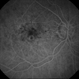 WET Age Related Macular Degeneration (WET AMD) WET Age Related Macular Degeneration (WET AMD)